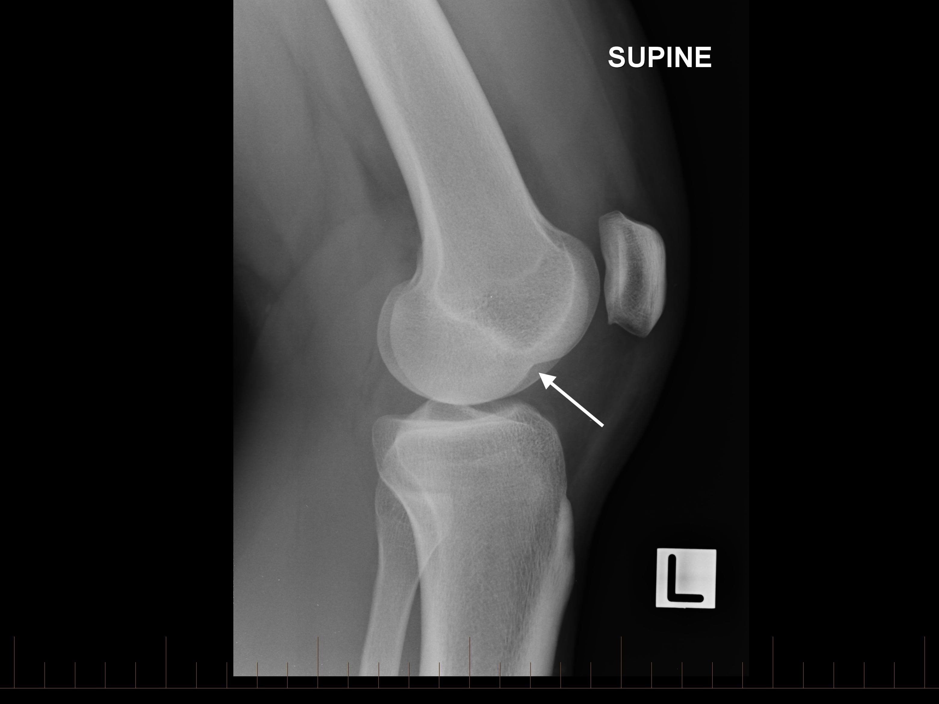Can We Diagnose ACL Injuries Based on X-ray Findings Alone? | Axis